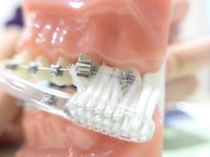 Prophylaxe Zahnpflege